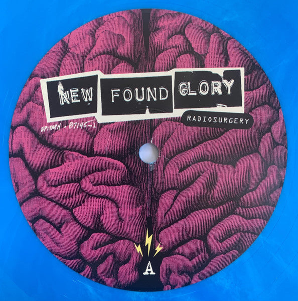 Radiosurgery - secondary